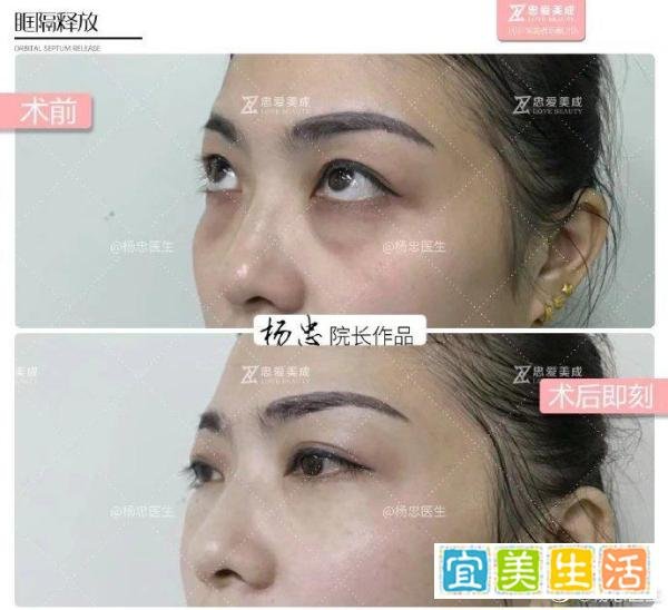 本人黑眼圈声明：跟私生活无关，请放心交友！