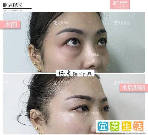 本人黑眼圈声明：跟私生活无关，请放心交友！