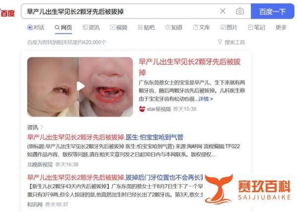 早产儿出生罕见长2颗牙先后被拔掉
