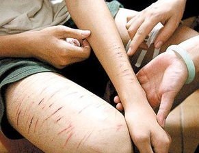 爱尔兰一女子自残吞55节电池：X光片不忍直视，她为何会有自残的行为？
