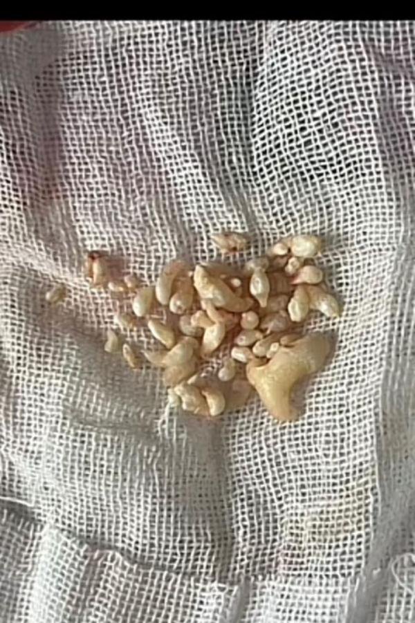23岁妙龄少女拔出57颗牙是什么体验?