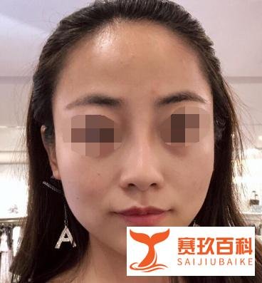 北京硅胶隆鼻案例术后55天