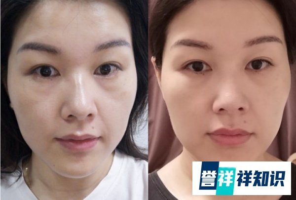 超声炮,美版超声刀,7D聚拉提,4D极速面雕,塑美极怎么样,有什么区别吗