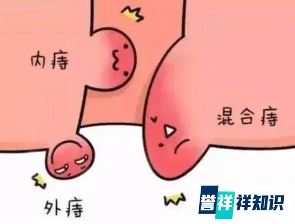 妈妈辅导作业被气到痔疮发作,临床上有这种情况吗?