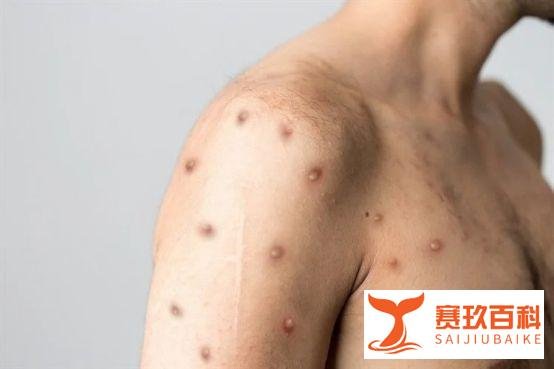 《柳叶刀》证实！大量猴痘患者同时感染猴痘与艾滋！