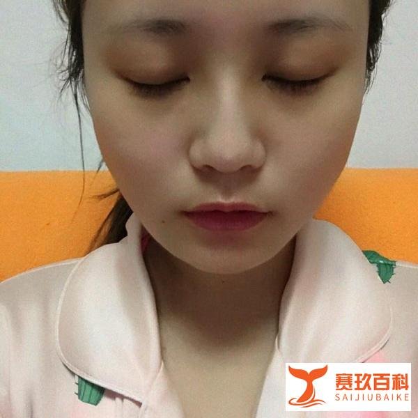 北京隆鼻医院医生价格22000，术后恢复记录分享