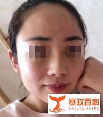 北京硅胶隆鼻案例术后55天