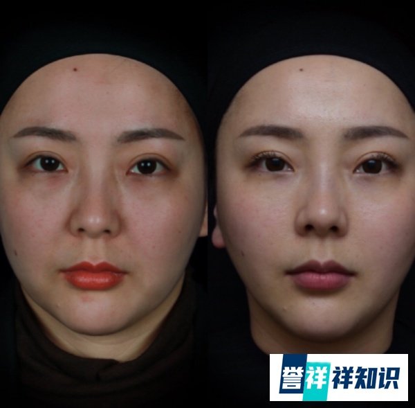 超声炮，美版超声刀，7D聚拉提，4D极速面雕，塑美极怎么样，有什么区别吗