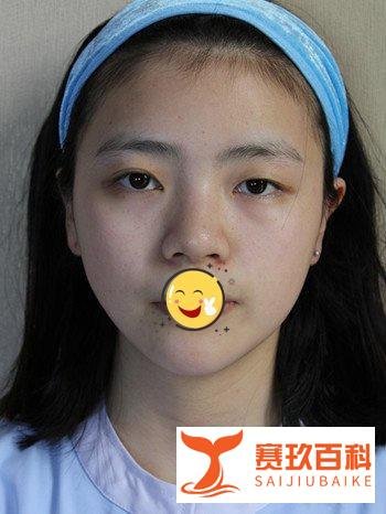 重庆割双眼皮医院医生价格7800,告别单眼皮
