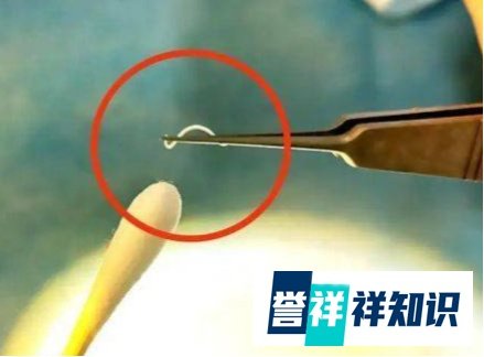 2岁男童眼睛现4条寄生虫游动
