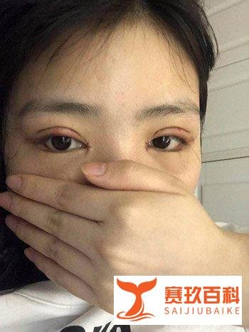 重庆割双眼皮医院医生价格7800,告别单眼皮