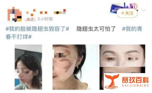 人民日报发文提醒!遇到“隐翅虫”第一反应要用力吹走,不可拍打