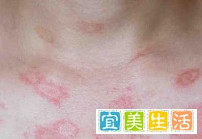 周海媚32岁患系统性红斑狼疮，25年后的死亡率超50%