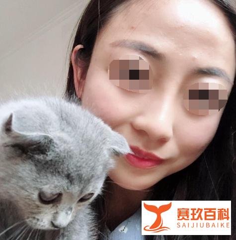 北京硅胶隆鼻案例术后55天