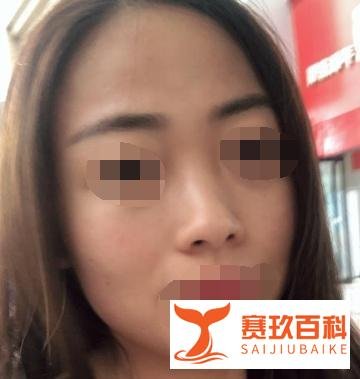 北京硅胶隆鼻案例术后55天