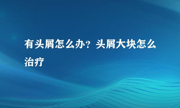 有头屑怎么办？头屑大块怎么治疗