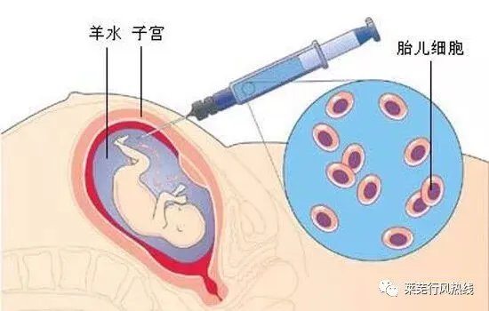 羊水穿刺