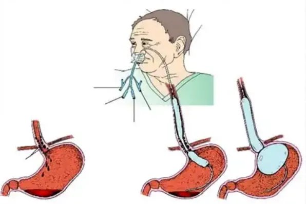 三腔二囊管使用方法图