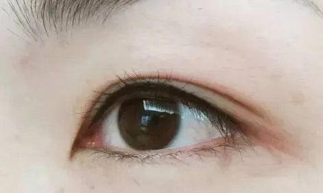 美瞳线手术有哪些后遗症?