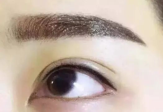 美瞳线手术有哪些后遗症?
