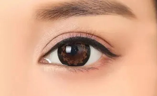 美瞳线手术有哪些后遗症?