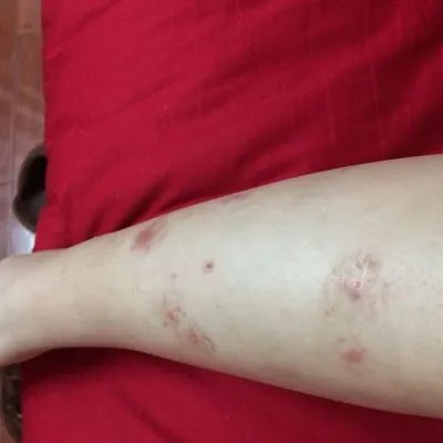 什么是牛皮癣?