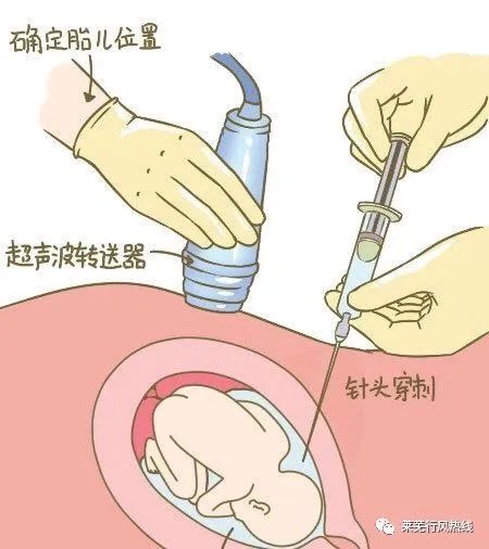 羊水穿刺