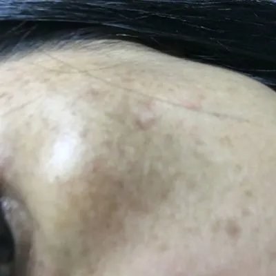 怎么消除日晒斑?