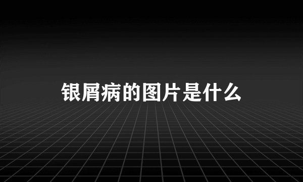 银屑病的图片是什么