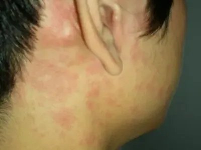 轻型麻疹耳周丘疹图片