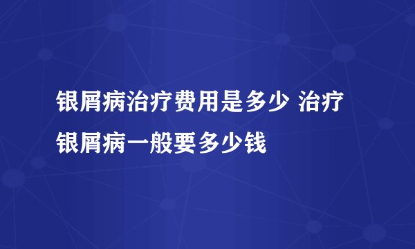 银屑病治疗费用是多少 治疗银屑病一般要多少钱