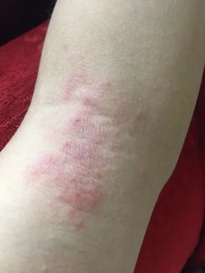 脂溢性皮炎症状?